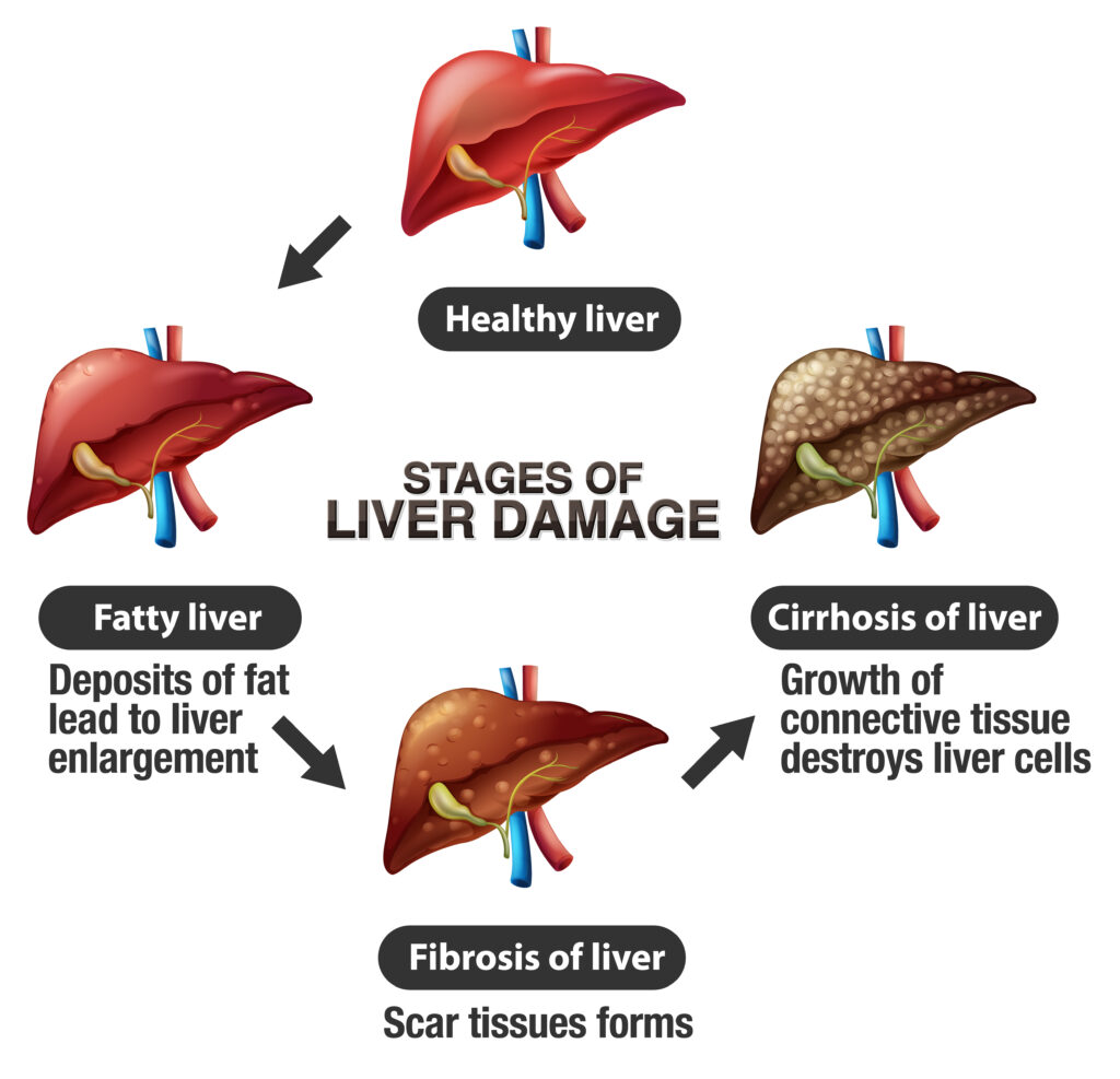 Unlock a Healthier You: The 21 Day Fatty Liver Diet Plan that Actually ...